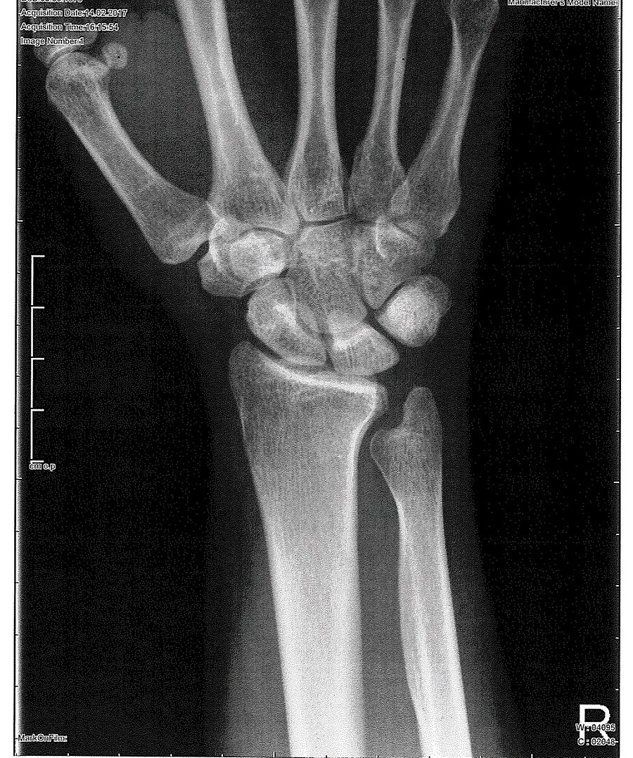 Ulna minus variante | Minus Elle | User im Austria-Forum